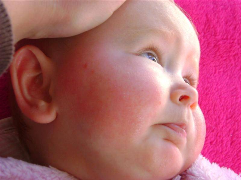 С чего начинается детская аллергия?